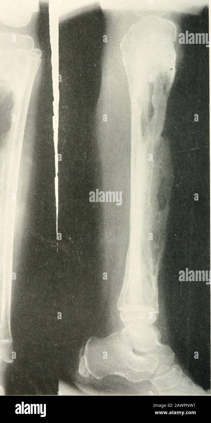 Studies from the laboratories of the Deptof Surgery . Fig. 20.—Clinical case Xo. lo. X-ray February 7. ipjo. Operation December 9. 1919. .interior surface of the cortex of the tibia removed. Dramage tube in popliteal space shown. See case history. the child who had a streptococcus ha?molyticus blood infection andwas treated with intravenous injections of peptone. After aboutfive weeks, granulations were seen springing ui) on the surface ofthe formerly necrotic shaft. X-rays taken two months after theprimary operation showed new bone formation about and appar-ently incorporating the remnant of Stock Photo