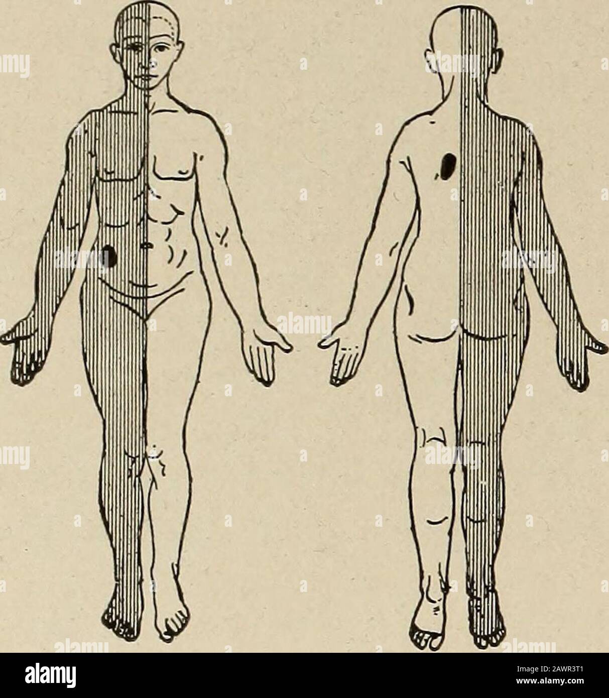 Nervous and mental diseases . junctiva, lids, and a cir-cular area about the eye are usually anesthetic. In hysterical deafnessthe auditory canal and concha are frequently insensitive. In hystericalaphonia the larynx may be anesthetic. Islets of anesthesia of peculiar and paradoxical outline are sometimesencountered. These may be many or few, and it often requires minuteand painstaking search to find them. 1 Phila. Med. Jour.. May 17. 1902. 592 NEUEOSES. Peculiarities of Hysterical Anesthesia.—1. In the first place,the outlines of limited hysterical anesthesias, excepting hemianesthesia,do not Stock Photo