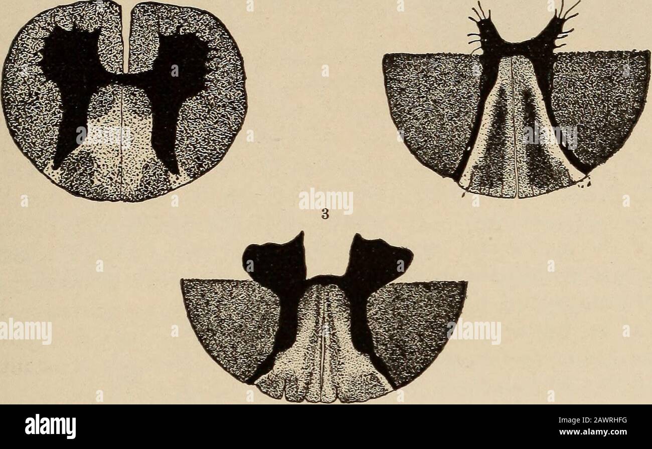 Tabes dorsalis hires stock photography and images Alamy