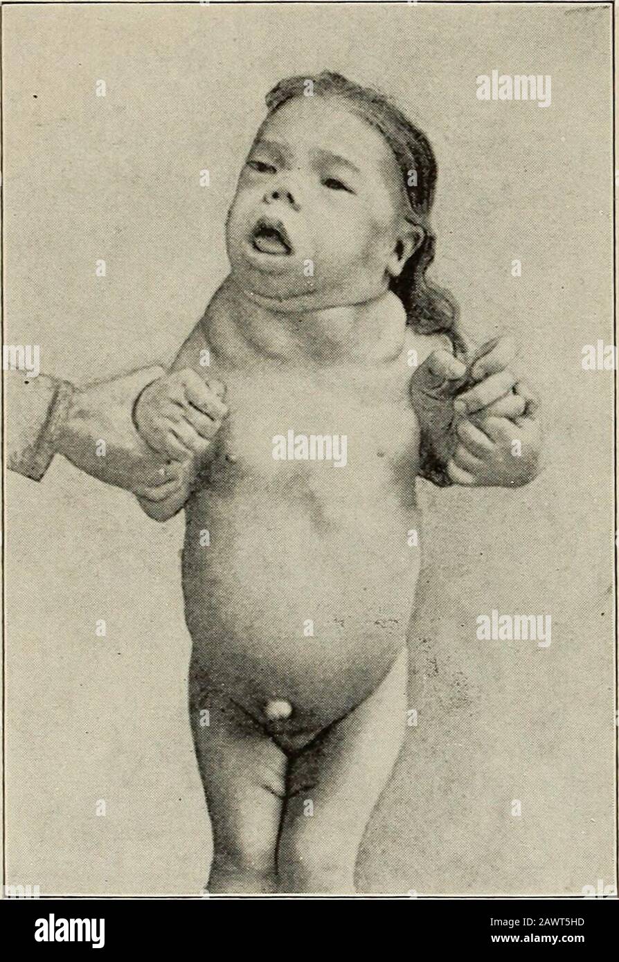 infantilism 