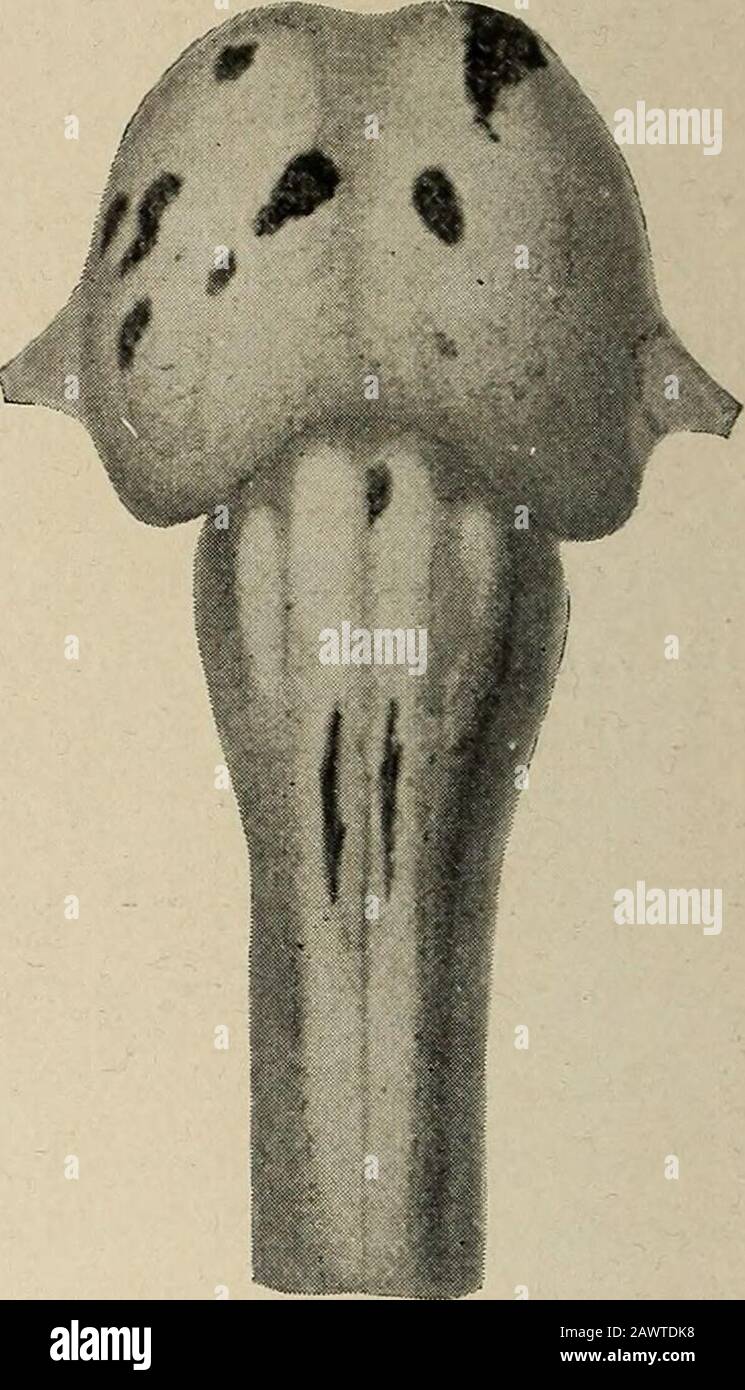 Nervous and mental diseases . Fig. 204.—Lesions of insular sclerosis in thebrain (Charcot). Fig. 205.—Lesions of the insular sclerosisin the pons and medulla (Charcot). toms of multiple sclerosis within a few weeks or months.2 Oppen-heim 3 found that in eleven out of twenty-eight cases treated by himthe patients had long been exposed to the influence of lead, copper,zinc, etc., and emphasizes the significance of occupations attended bysuch intoxications. Charcot, in one of his later lectures, reported acase consecutive to cerebral rheumatism. Infection may explain someof the family groups of m Stock Photo