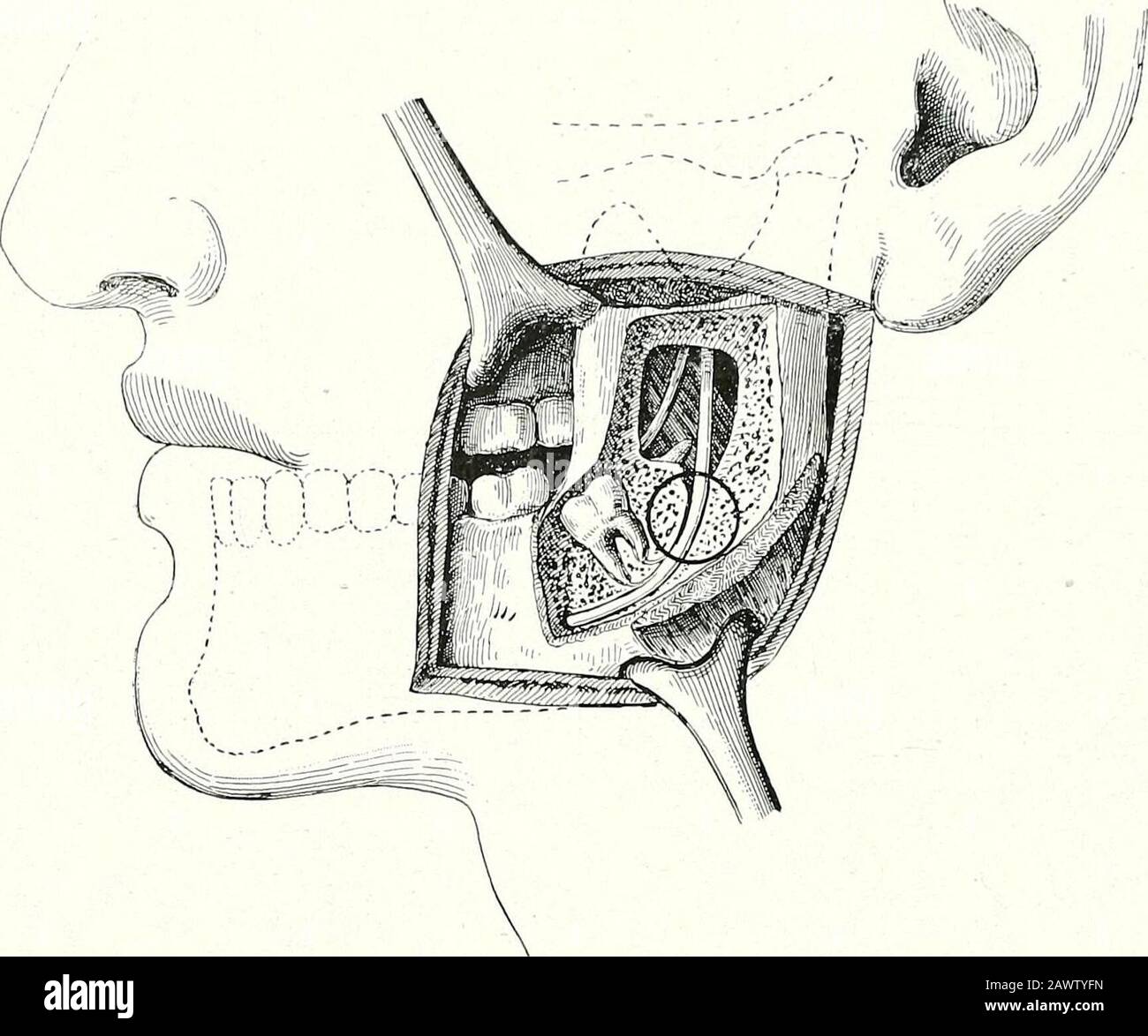 Surgical therapeutics and operative technique . uced, staphylorrhaphy
