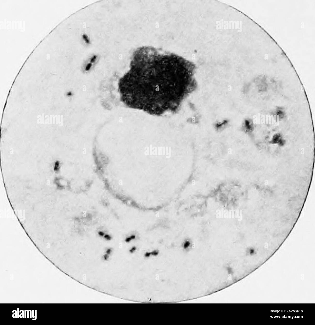 Essentials of bacteriology; being a concise and systematic introduction to the study of bacteria and allied microörganisms . Fig. 70.—Bacillus pneumoniae of Friedlander, from the expectoration of apneumonia patient (Xiooo) (Frankel and Pfefeer).. rig. 71.—Diplococcus pneumoniae in exudate from human lung; anilin-water-fuchsin; Weichselbaum prep. (Kolle and Wassermann). BACTERIA IN PNEITMONIA 157 lieved it to be the real cause of pneumonia. It is the generally-accepted organism of the disease, and can be isolated fromnearly all cases of acute croupous pneumonia. It is found inabout three-quart Stock Photo