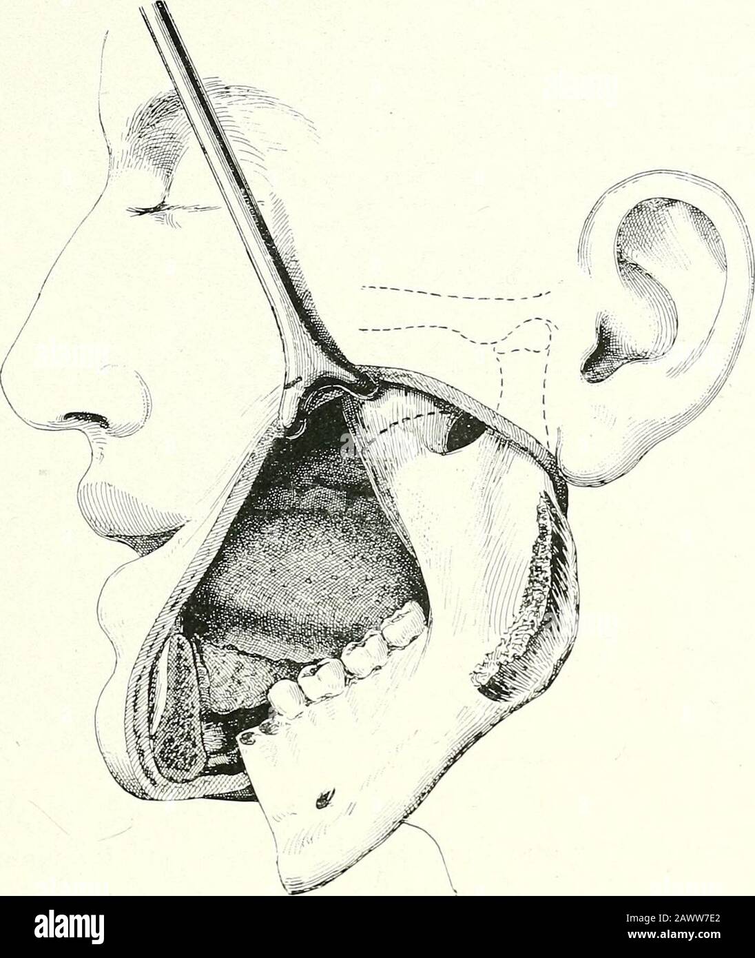 Surgical therapeutics and operative technique . Fig. 177.—Unilateral Resection of Inferior Maxilla.A curved forceps is passed behind the bone to protect the soft parts from the saw. Total Resection of the Inferior Maxilla. 1 have had to remove the whole lower maxOla for an osteo-sarcomawhich involved nearly the whole of the horizontal portion of the bone ina girl aged twenty. The operation was decided on after curettage, andhistological examination of the principal neoplastic focus. The incision,made as described above, enabled me to free the bone at its median part.The maxilla, of which the t Stock Photo
