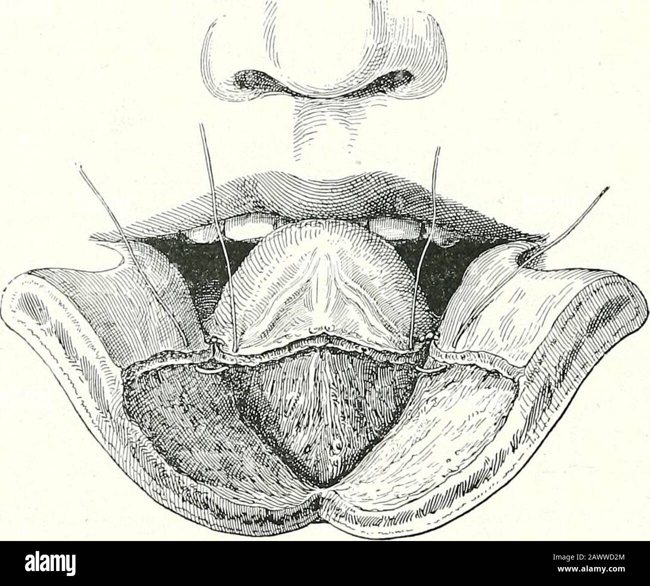 Surgical therapeutics and operative technique . - Vith either a small saw with movableback, or with a circular saw worked by electricity. We take care to protectthe soft parts with a long curved forceps introduced beneath the bone at. Fig. 171.-—Partial Eesection of Median Portion of Lower Jaw. Suture of lingual to gingival mucous membrane. The divided surface of the maxillahas already been covered by the suture. the chin, and made to emerge between the dental arches (Figs. 177 and 181).The bone is held by the left hand with a gouge-forceps, while we sawthrough it with the right. Division of t Stock Photo