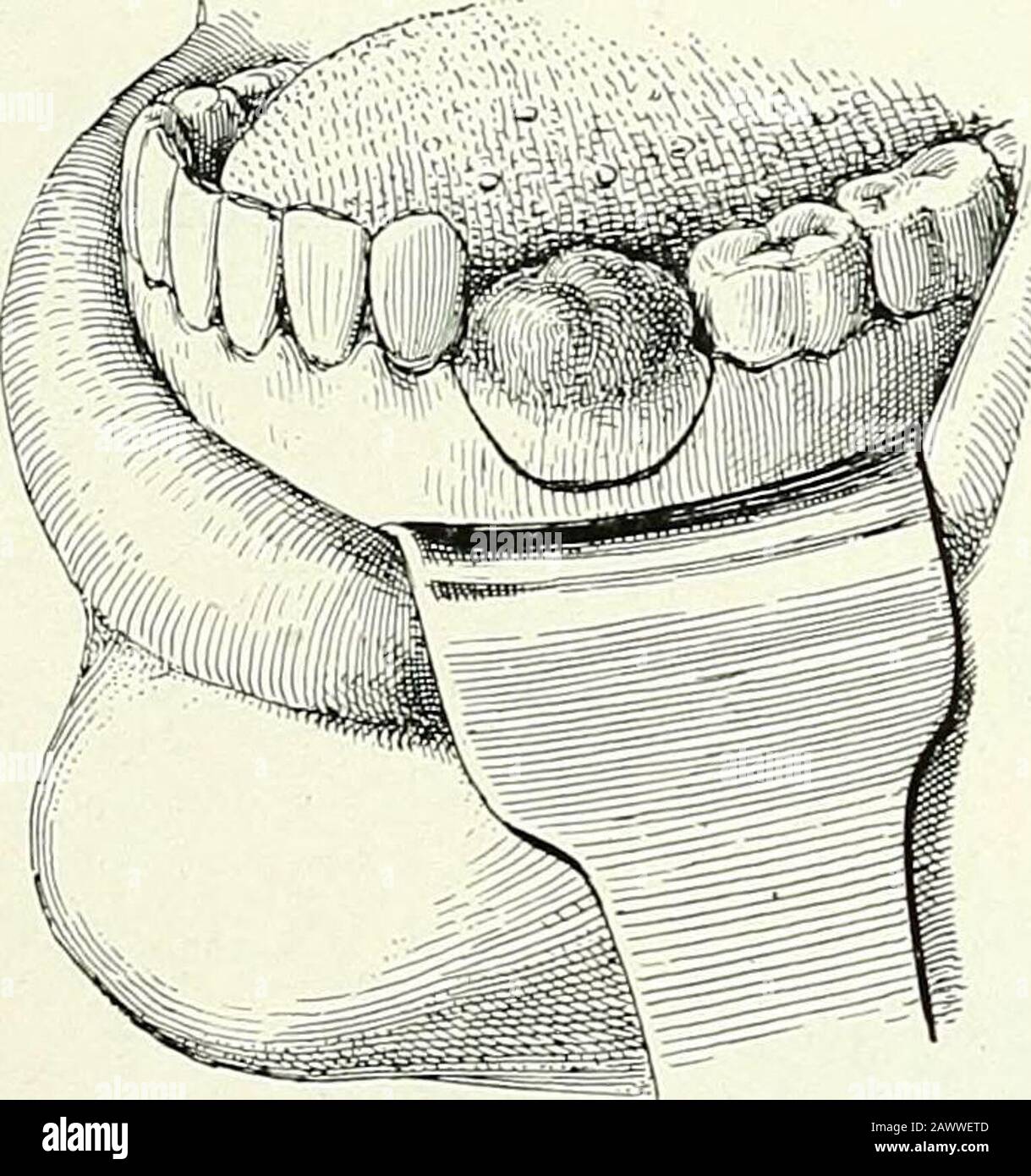Maxillary second molar hires stock photography and images Alamy