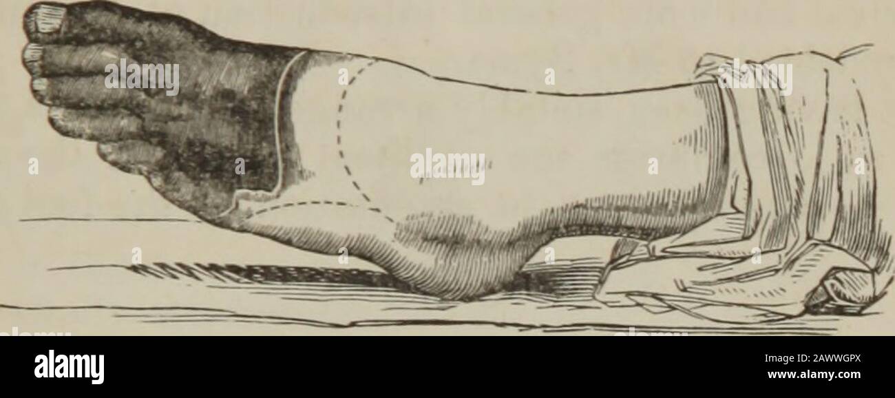 The practice of surgery . secured, the flaps are adjusted by sutureand strap. In operating on the left foot, the dorsal incision is begun over thearticulation of the metatarsal bone of the great toe with the internalcuneiform bone, and terminates behind the prominent head of themetatarsal bone of the little toe; in other respects the operation is thesame. KESECTION OF THE ANKLE. 697 CJwparts Operation.—Amputation may be performed still higher,leaving a useful stump. Disarticulation is effected between the astra-galus and the navicular bone; all the bones of the foot and tarsus beingremoved, ex Stock Photo