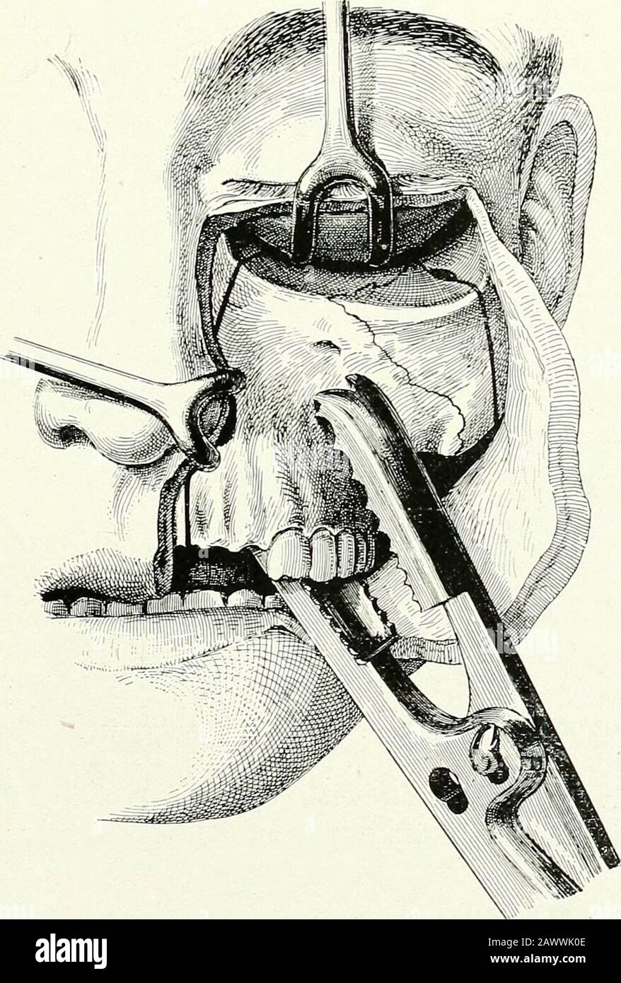 Surgical therapeutics and operative technique . Fig. 156.—Position of the Forceps for Section of the Palatine Vault (2),AND FOR Pterygo-Maxillary Disjunction (4).. Fig. 157. The superior maxilla, freed from its attachments, is removed with FaraboBuis forceps. 76 SURGICAL THERAPEUTICS AND OPERATIVE TECHNIQUE recourse to radiographic examination, which reveals the smaller prolonga-tions of the neoplasm, and especially the distant foci; and make a micro-scopic examination of a characteristic fragment, removed at a suitablepoint after local anaesthesia with cocaine. Partial Resection of the Superi Stock Photo
