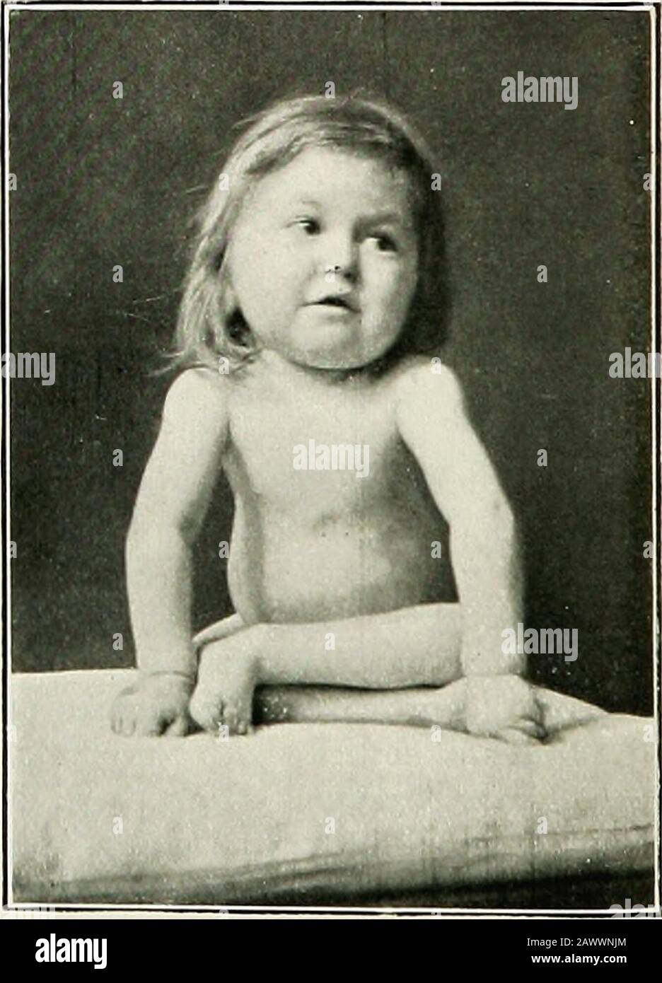 The medical diseases of children . termed acrobaticrickets. In rickety ...
