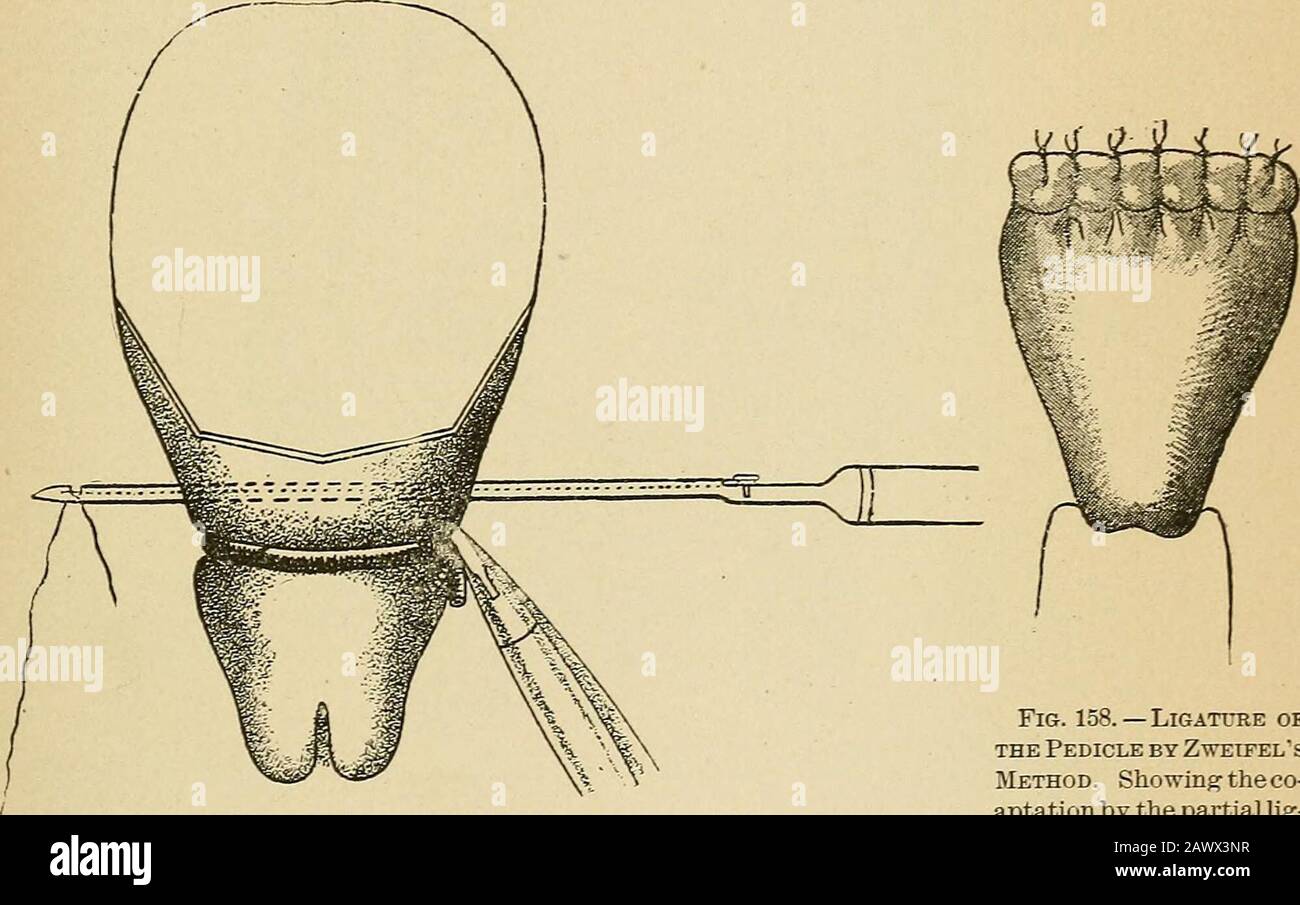 Treatise on gynæcology medical and surgical . a groove which resembles Reverdins; the point is