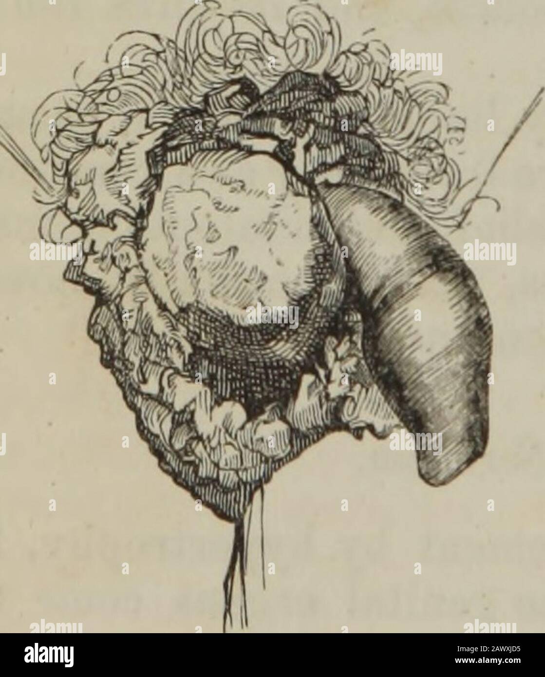 The practice of surgery . Hypertrophy, or Elephantiasis of the Scrotum, ina Hindoo. Fig. 243.. An aggravated example of Chimney-sweepers Can.cer; much superficial texture destroyed. however, such an attempt may behazardous, the patient being apt toundergo fatal exhaustion, under thetedious and painful operation, andthe copious loss of blood. It isthen better, probably, to sacrificeeverything, and to effect removal,at once, by a few rapid strokes of along bistoury. Before proceeding toany operation, however, and moreespecially to summary ablation, itis most necessary to ascertain whe-ther or no Stock Photo