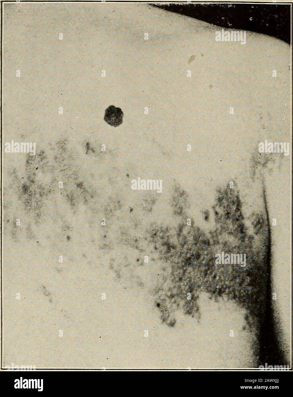 Genitalis herpes Genital herpes