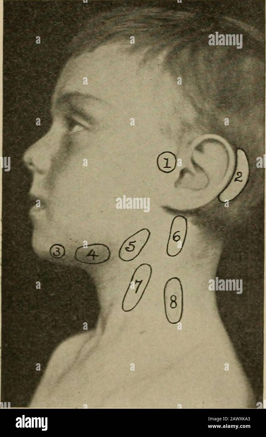 Diseases of children for nurses . s towardthe center. Tinea Tonsurans.—A ring-worm of the scalp. Lupus vulgaris is tuberculosis of the skin. Nevus or Birth-mark.—A collection of blood-vesselsin the skin. They are characterized by a raised purplisharea. They should be excised if they cause disfiguration. Pediculosis Capitis, or Lice.—Small parasites infest-ing the hair. Pediculosis Pubis.—Small parasites infesting pubichair. Nursing.—-To obtain results in skin diseases it is neces-sary to be patient and to apply the remedies thoroughly. DISEASES OF EYE, EAR, SKIN, AND GLANDS 239 All crusts shou Stock Photo