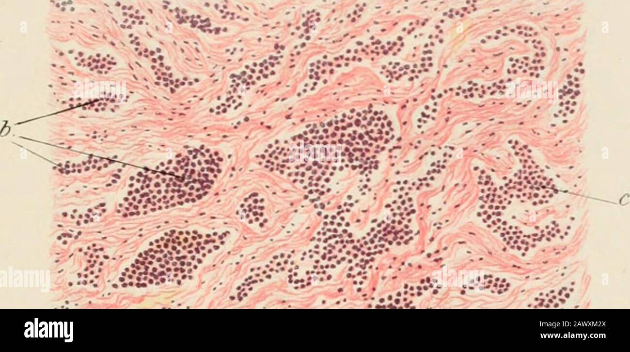 Cancer cells in tumour hi-res stock photography and images - Alamy