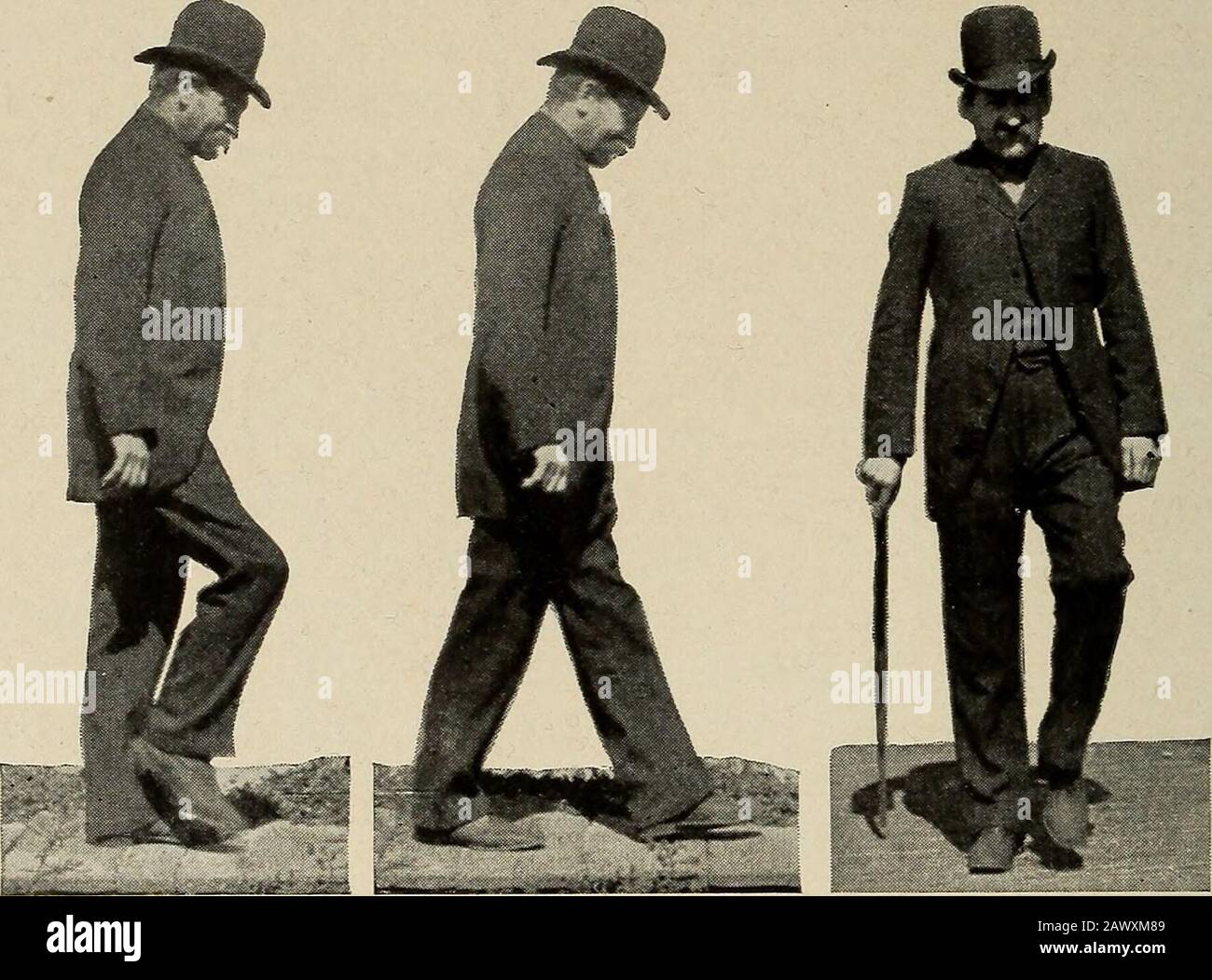 Nervous and mental diseases . ••- -^ Fig. 115.—Drop-foot and deformities in alcoholic multiple neuritis.. Fig 116.—Gait in multiple neuriti showing the high knee-action and the dangling foot descending byits toe and outer border. patient in such cases in walking brings the heel first to the groundwith the foot everted and dorsally flexed. When the thigh-extensors are also affected and the muscles at the rootof the limb are weakened, the use of the member becomes well-nighimpossible. A paresis of the extensors of the knee is often associatedwith that of the leg muscles in alcoholic polyneuritis Stock Photo