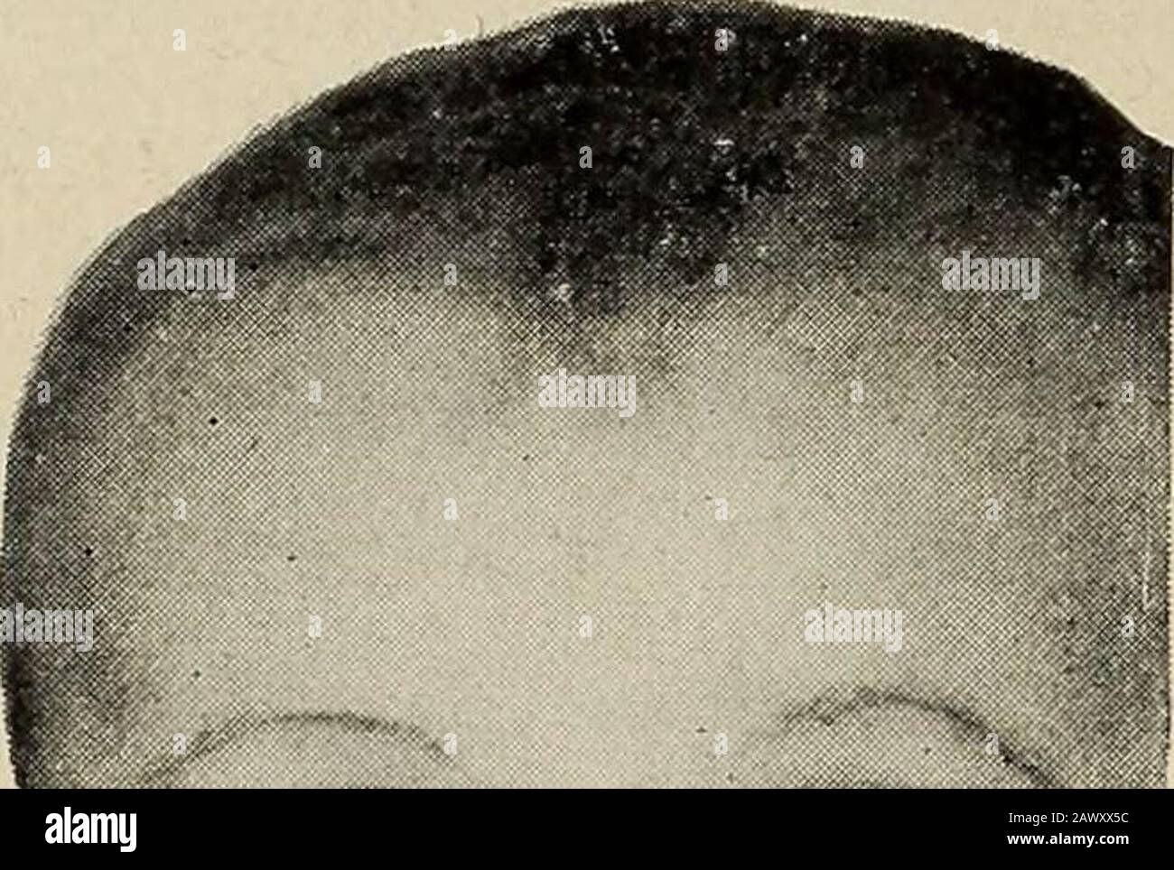 Nervous and mental diseases . key to diagnosis. Disease of the cervical vertebrae, as Potts disease ; of the meninges, as cervical pachymen-ingitis ; or diseaseof the cord, assyringomyelia, mayinvolve the brachialnerves in varyinggroups. Neuritis of thebrachial plexus isa rather commoncondition that isusually mistaken fora neuralgia, anginapectoris, or a rheu-matic trouble inthe shoulder andarm. According toGowers, who firstcarefully described it, brachial plexus neuritis is analogous to sciaticneuritis in the lower extremity. Causes.—This disease of the brachial plexus is encountered mainlyaf Stock Photo