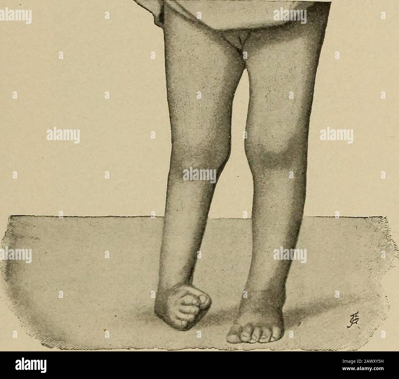 Diseases of children for nurses . Fig. 57.—Scissors gait in a girl two years old (Friihwald and