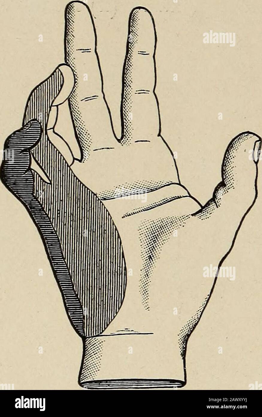 Nervous and mental diseases . uctor andopponens and can not be adducted. The fingers lose all lateral motion. 296 DISEASES OF SPINAL MENINGES AND SPINAL NERVES. The distortion and deformity that result are pronounced and charac-teristic. There is overextension at the metacarpophalangeal joints,which makes the head of the metacarpal bones prominent in the hollowedpalm. The unopposed flexors claw the second and third joints, andwith the strongly-acting common extensor increase the deformity. Thisis least marked in the index and middle fingers, which do not lose theirlumbrical muscles. All the in Stock Photo