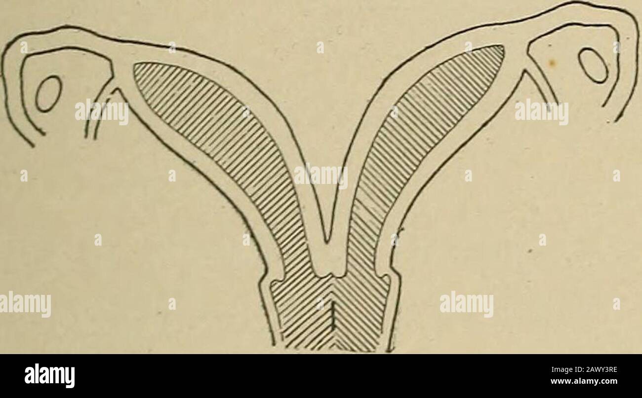 Gynecological diagnosis . Fig. 72.—Uterus Bipartitus. Fig. 73.—Uterus Didelphys.. Stock Photo