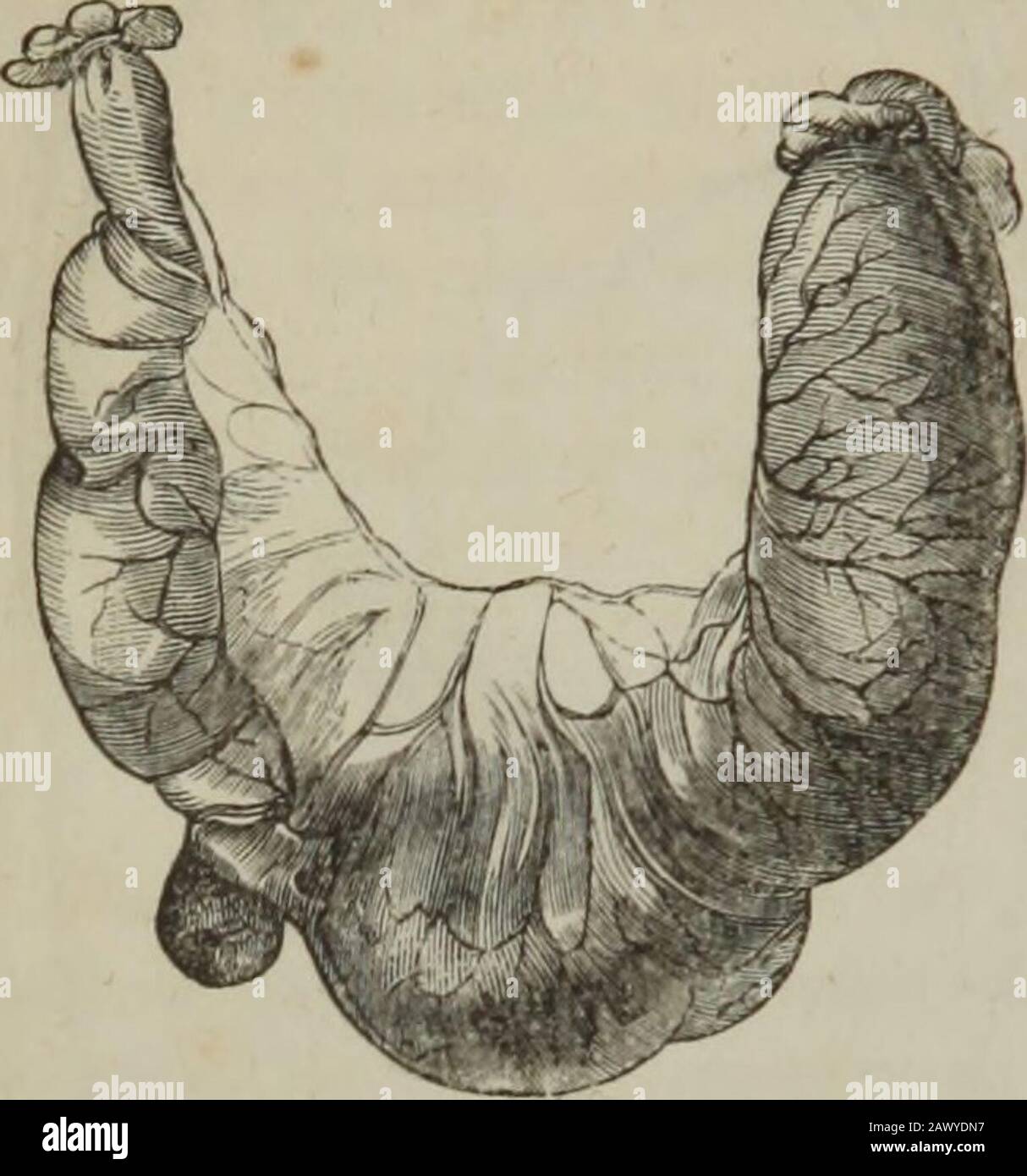 The practice of surgery . 408 FEMORAL HERNIA. Fig. 180.. Portion of Bowel, not including its wholecaliber, which was caught and strangled atthe crural aperture; the symptoms, thoughmodified, proving fatal. During life, no tumorcould be discovered at the site of protrusion.(Liston. His Elements, p. 536.) pendent of it; formed by the inner and anterior part of the crescentic portion of the crural arch; felt tight,on the inside of the tumors neck, whilethe fingers point is yet at some distancefrom the actual brim of the pelvis. Thisresistance is divided by a probe-pointedbistoury, slid flatly alo Stock Photo