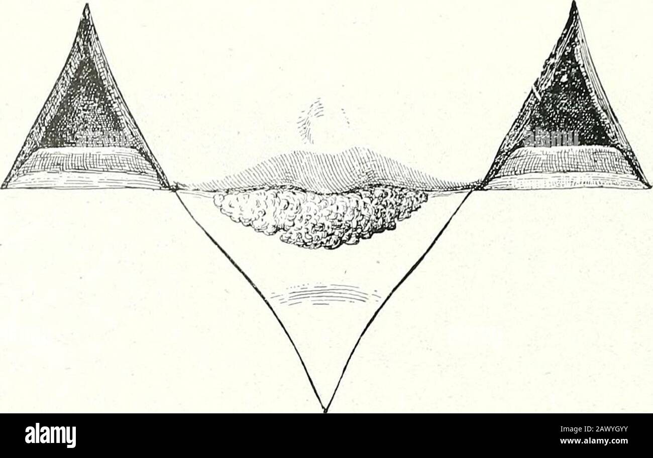 Surgical therapeutics and operative technique . Fig. 59.—The Same ...