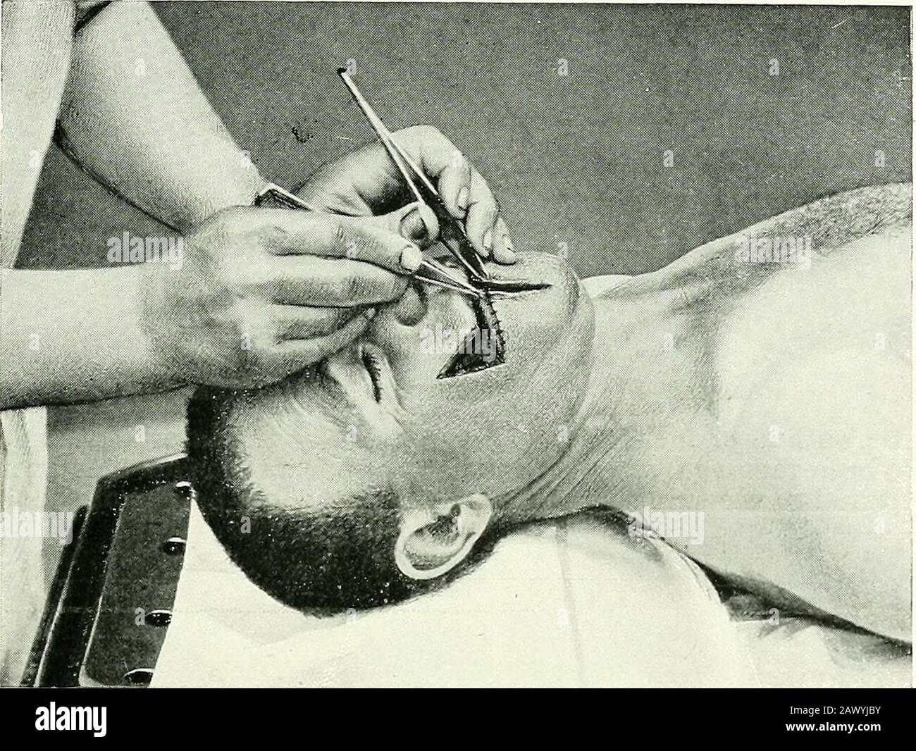 Surgical therapeutics and operative technique . Fig. 57.—The Same. The buccal mucous membrane has been sutured to the skin so as to reconstruct the lip. OPERATIONS ON THE HEAD 25. Fig. 58.—The Same.Median reunion of skin. Stock Photo
