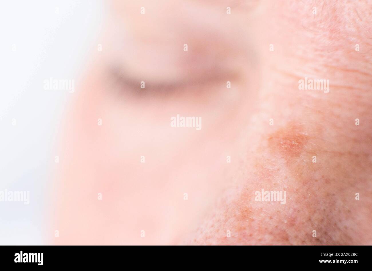 age spots on the face of a woman with dry skin and wrinkles, background