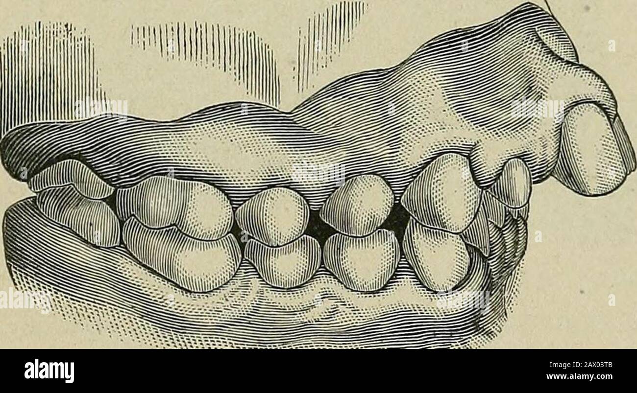 the etiology of osseous deformities of the head face jaws and teeth pig 217 pig 218 fig 219 elongation of the lower anterior alveolar arch a circumstanceto be noted in these cases the eruption of the first per manent molars determines the relation of the jaws to eachother occasionally they do not develop their full length ineither case the lower incisors strike against the mucous mem brane of the roof of the mouth which constant irritationstimulates the deposition of the bone cells in the process as ifnature would defend it against the abnormal pressure of thelower teeth were 2AX03TB
