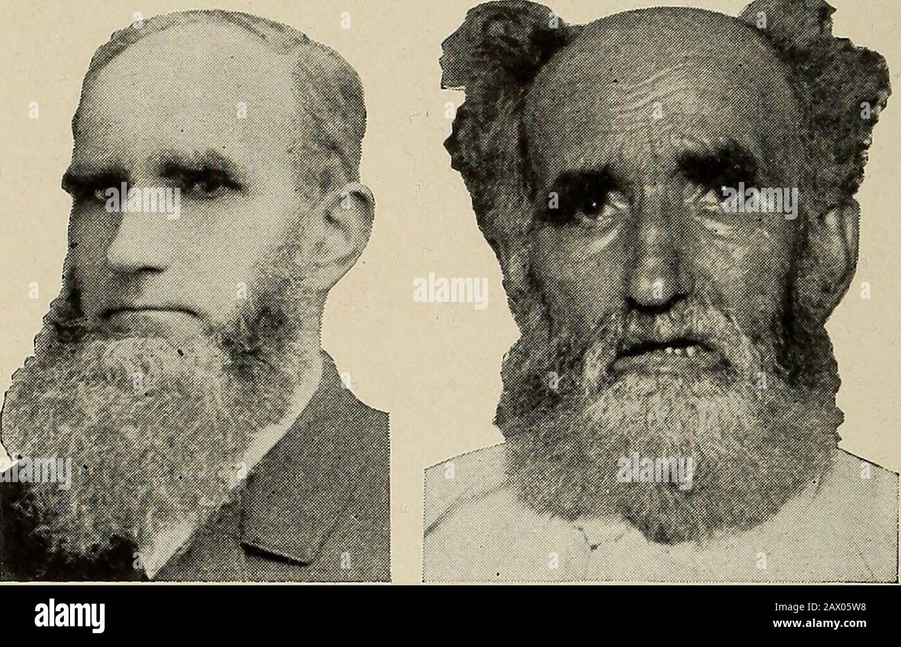 Tabes dorsalis hires stock photography and images Alamy