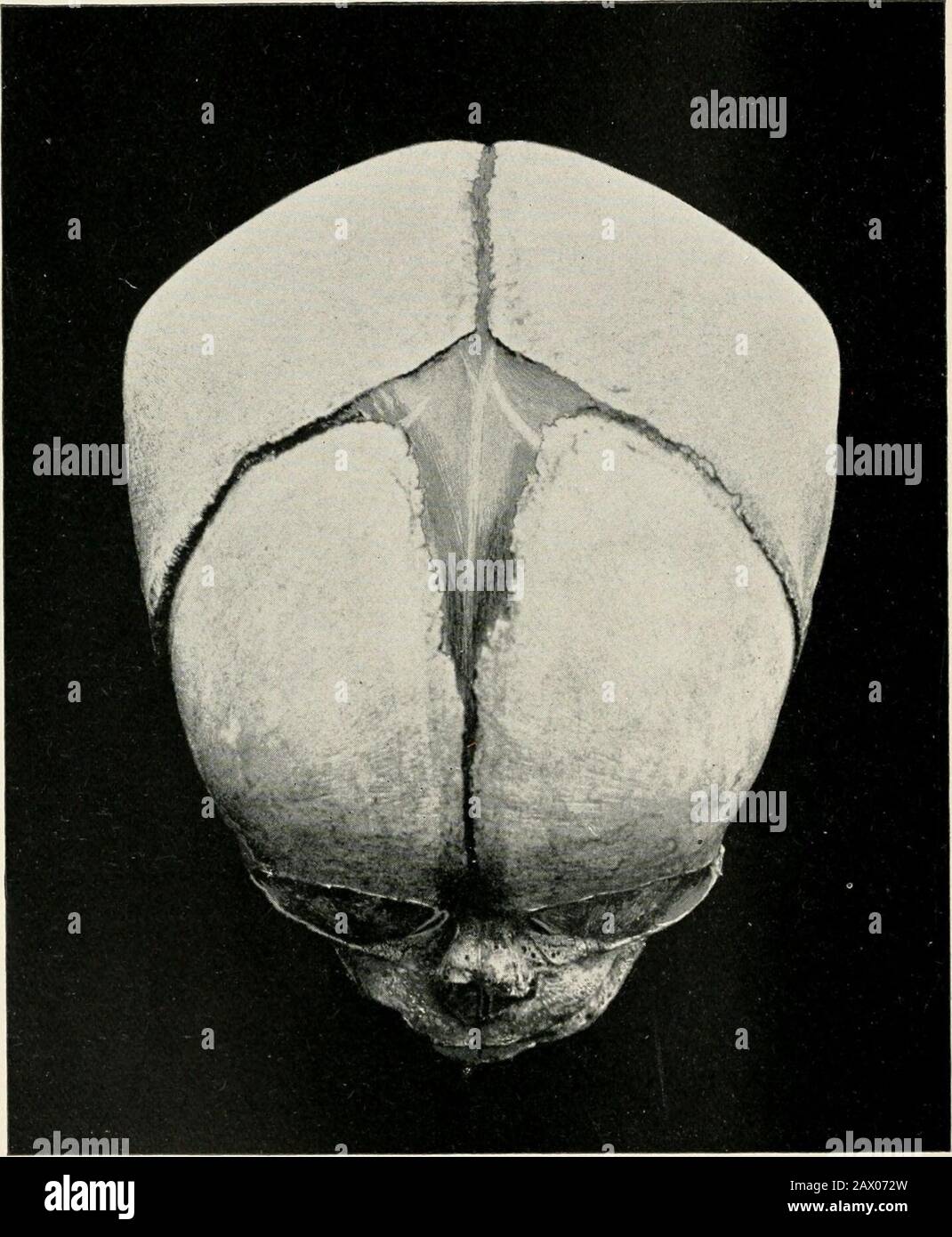 A Text Book Of Practical Obstetrics Comprising Pregnancy Labor And The Puerpal State And Obstetric Surgery Front View Of The Fcetal Skull Showing The Anterior Fontanelle And The Coronal And Frontal Sutures