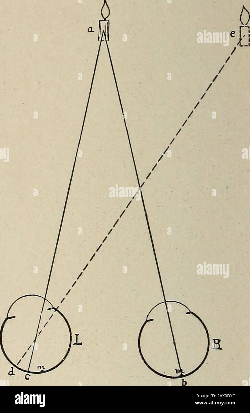 Nervous and mental diseases . Fig. 38. Fig. 39. Fig. 38. Convergent squint. The ray of light, a c, falls to the right of the sensitive spot, m, ofthe inturned left eye, L. Such stimulus has always been recognized by the mind as emanating fromobjects to the left, and not realizing the disordered position of the ocular globe a false image, e, is pro-jected an additional distance to the left, measuring from c as the operating sensitive spot, in theline d e. Fig. 39.—Divergent squint. The ray of light, a c, falls to the left of the macula, m, of the outwardlyturned left eye, L. Such stimulus has a Stock Photo