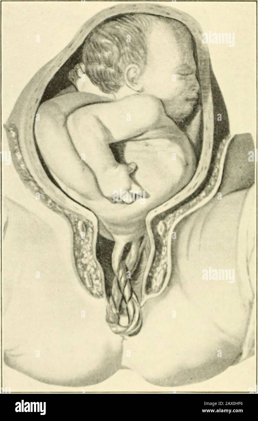 A textbook of obstetrics . Fig. 252.—Trunk presentation, dorsal