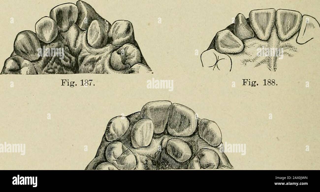The etiology of osseous deformities of the head, face, jaws and teeth . Fig. 186.. Fig. ixi. When the diameter of the upper arch is greater than that ofthe lower, its laterals may be found within the line of thecentrals and cuspids. In this case the lower incisors musteither strike over the upper, which occurs when there is aproper relation of diameters of upper and lower maxillae, orelse they may strike behind the upper laterals, which canoccur only when the upper arch has a greater diameter thanthe lower. THE HEAD, FACE, JAWS AND TEETH 441 6. A rotation of 90°, so that the lateral is at rio^ Stock Photo