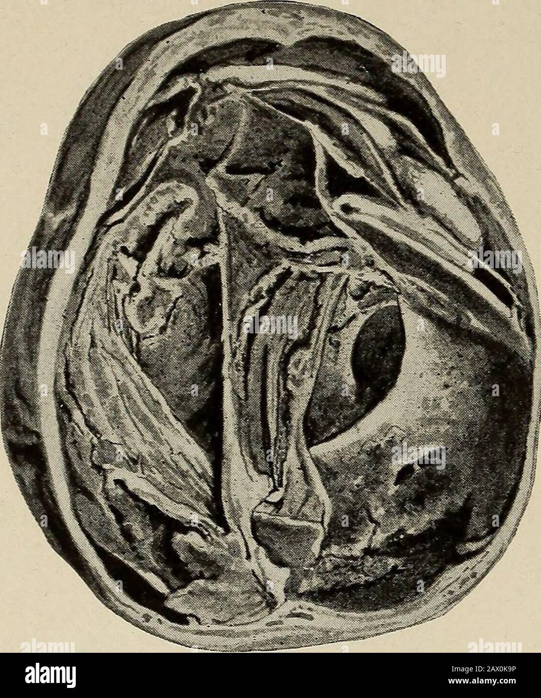 Nervous and mental diseases . ess is purely inflamma-tory, are very vague. In manycases no suspicion of the diseasehas been raised during life. The first recognizable symptoms attendthe formation of a hematoma large enough to produce cerebral indica-tions. These consist of pain in the head, intellectual troubles, loss ofmemory, awkwardness in muscular movements, insomnia, vertigo,rarely vomiting, limited or Jacksonian convulsions, apoplectiform attacks,rigidities and monoplegias presenting remissions. The temperature isfickle and uninstructive. During the convulsive attacks it attains ahigh de Stock Photo