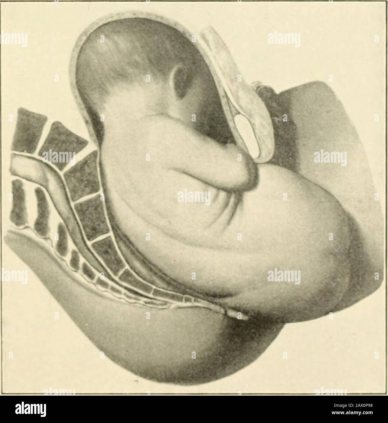 A textbook of obstetrics . Fig. 240.—Same as figure 237, showing escape ...