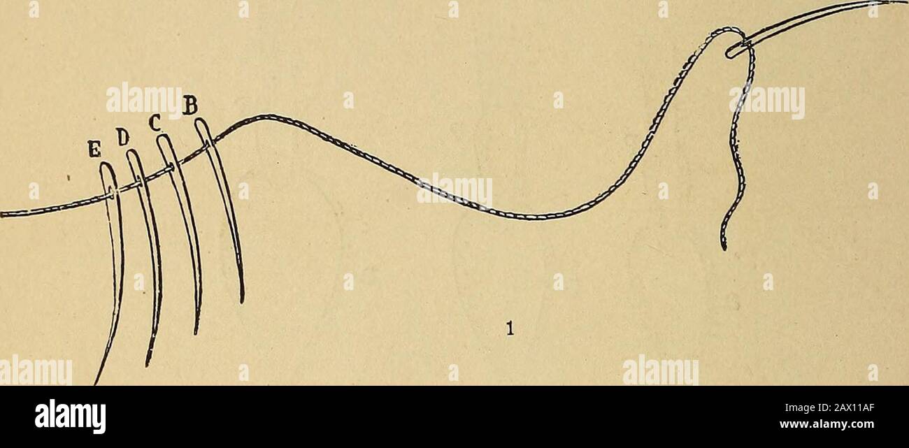 Treatise on gynæcology medical and surgical . hreads in place,the