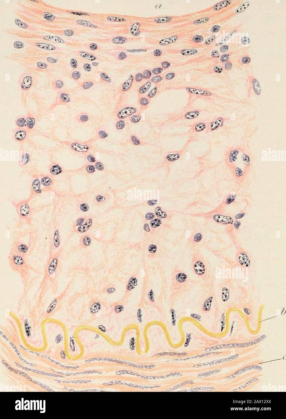 Practical pathology; a manual for students and practitioners . of cerebral artery showing syphilitic endarteritisobliterans. Stained with alum hxmatein and van Giesons stain.( X 100.) a.a. Channels left representing the lumen of the vessel, near which are flattened cells representing the endothelial layer.i.e./. Internal elastic lamina.int. Thickened and cellular inner coat in which small bloodchannels may be seen. Cells derived from internal cells bya process of proliferation.med. Muscular coat rclatiiH-ly thin.adi. Greatly thickened and very cellular tunica advenlitia. vessel differs in no e Stock Photo