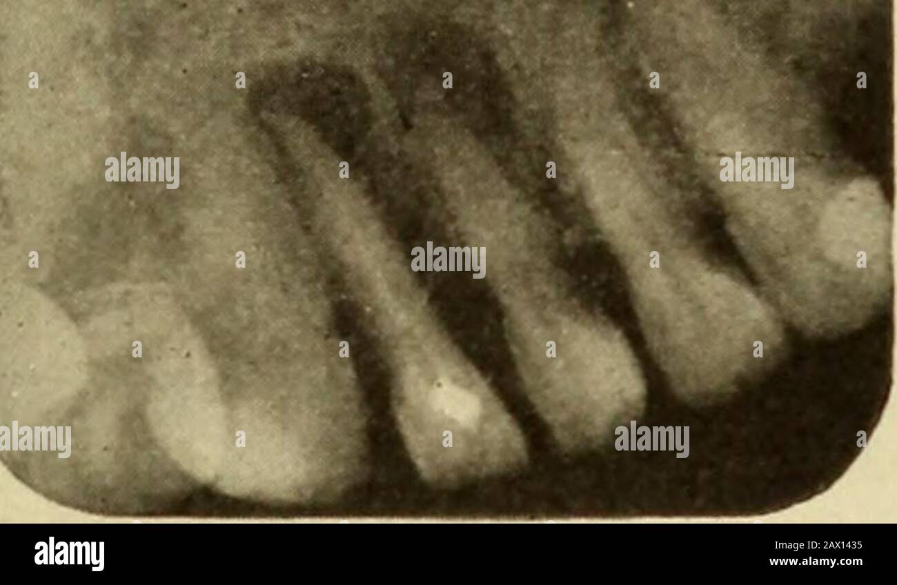 Diseases Of The Soft Structures Of The Teeth And Their Treatment A Text Book For Students And Practitioners In Gt Hronir Il Turbances Of Tin Tissues Surrounding The Rool Of A Pronouncedly (comparative more pronouncedly, superlative most pronouncedly). alamy