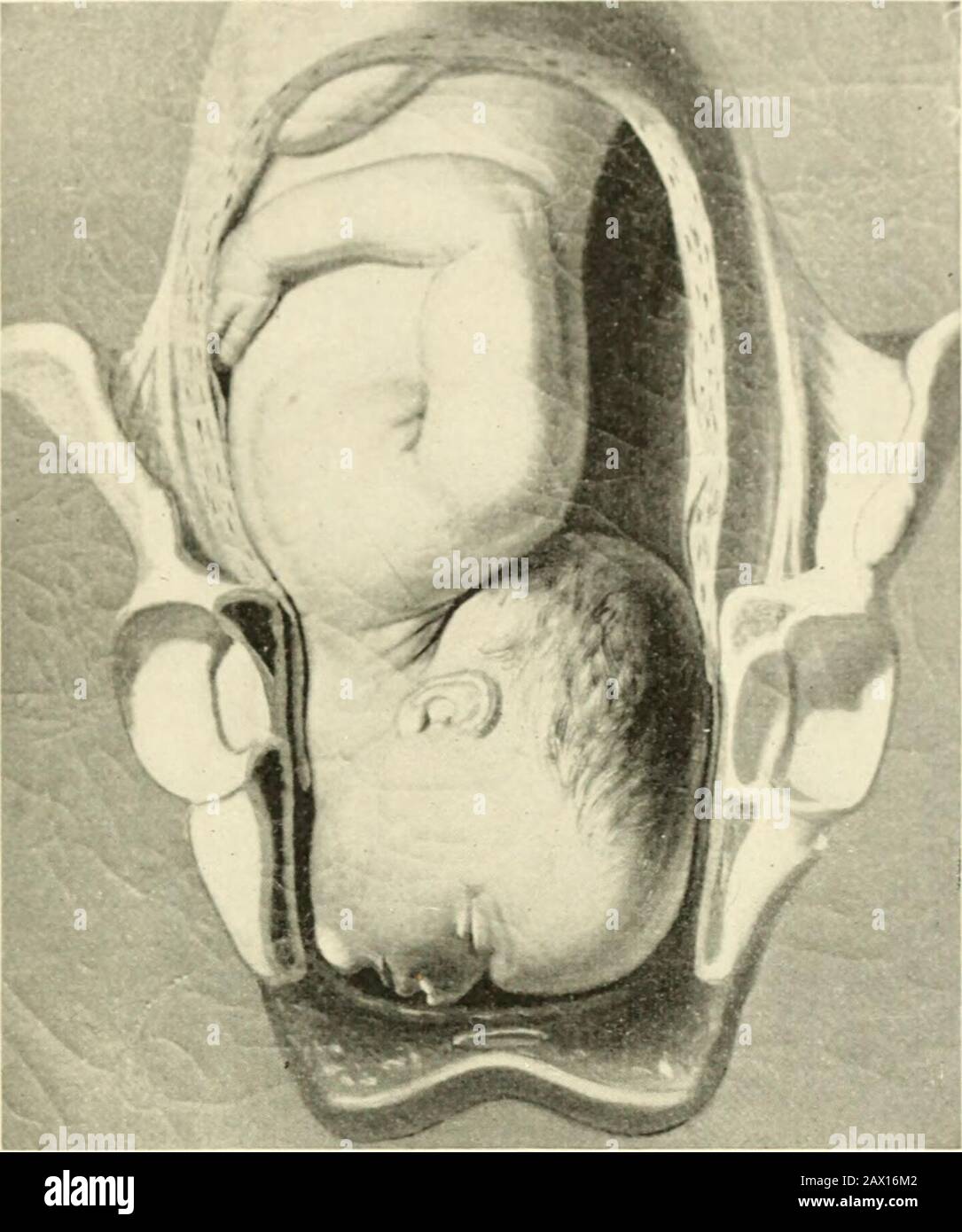 A textbook of obstetrics . hen follows the delivery of the head by flexion and propul-sion, the mouth, nose, eyes, and forehead sweeping over the peri-neum and appearing successively at the posterior commissure. Restitution and external rotation follow the escape of thehead from the same causes that impose these movements uponthe head in a vertex presentation. The delivery ot the bodytakes place as in a vertex presentation. Abnormalities in Mechanism.—The most common and mostimportant anomaly of mechanism is a delay in the forwardrotation of the chin under the symphysis. This delay isdm- to th Stock Photo