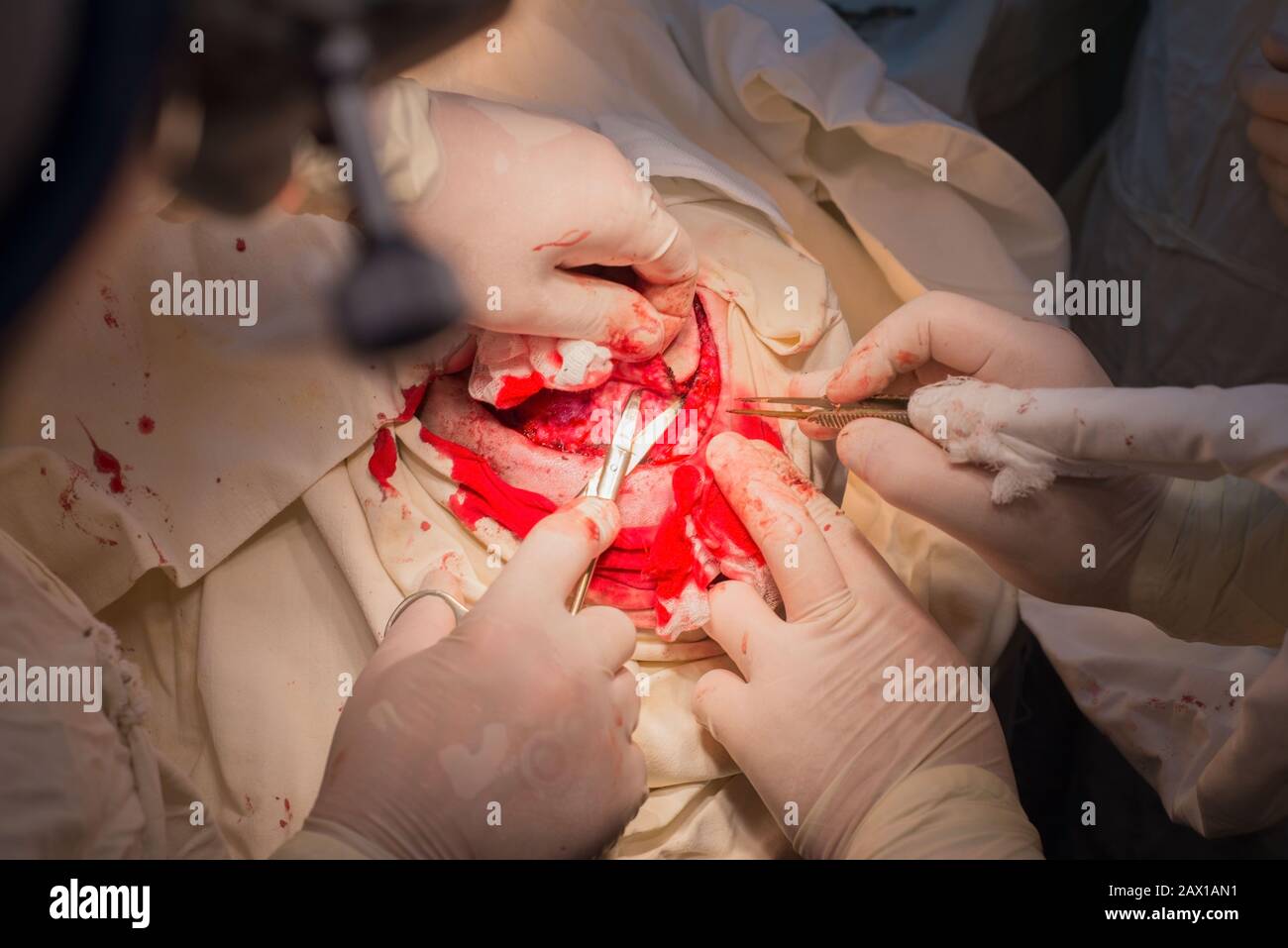 top view, stages of neurosurgical surgery for installing a titanium plate in the patients skull. Pediatric neurosurgery. Craniotomy. Incision of the s Stock Photo