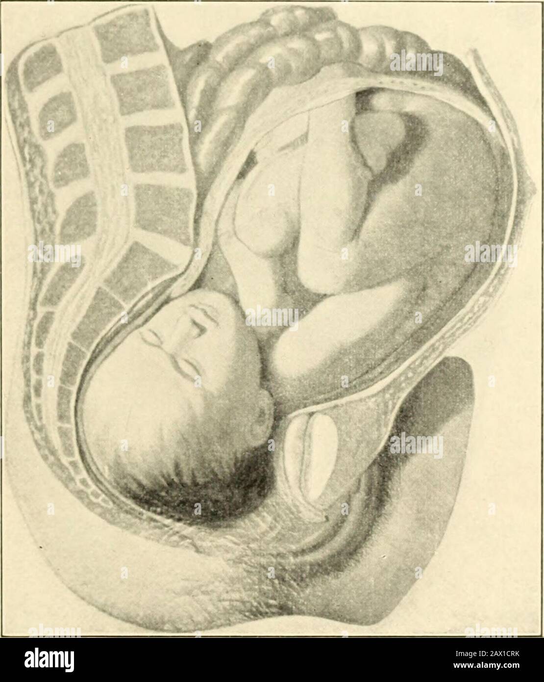 A textbook of obstetrics . thepelvic walls. Third Step.— Dilatation of the lower uterine cavity and of thecervical canal. Fourth step.—Descent of the head to the pelvic floor, mainlyby an extension of the fetal spine. The fetal body, as a whole,is not yet propelled along the birth-canal, because, during a painand while the head is obviously descending to the pelvic floor,the fundus uteri and the breech do not sink to a lower level. MECHANISM OF PRESENTATIONS IND POSITIONS. 6 On the contrary, there is a slight elevation of the fundus, anelongation of the uterus, and the distance between the h Stock Photo