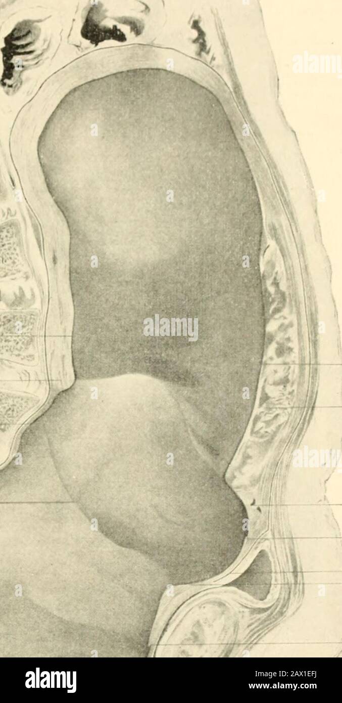 A textbook of obstetrics . Fig. 211.—Vertex presentation, Kit occipitoanterior position. the different positions and presentations of the fetus being readilyunderstood if the typical mechanism of the commonest presenta-tion and position is thoroughly mastered. It is convenient to divide the mechanism o labor into anumber of steps or acts, as follows : lirst Step.—Accommodation of the size of the fetal skull tothe size of the pelvic canal by llexion ; accommodation of the shape MECHANISM OF PRESENTATIONS AND POSITIONS. 359 . h. V Fig. 212.—Genital tract with fetus removed, showing divergence o Stock Photo