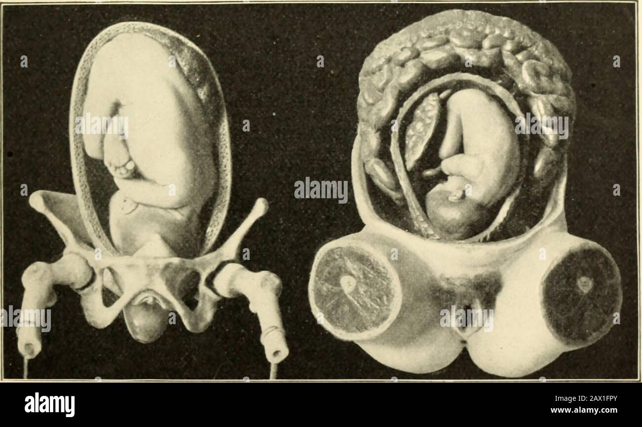 A textbook of obstetrics . Fetal skull seen from the side, (2) from above, (3] from behind, and ] from in front,showing sutures, fontanels, and diameters. MECHANISM OF PRESENTATIONS AND POSITIONS. 357 Possible Presentations of the Head.— Vertex. — By this term ismeant that conical portion of the skull with its apex at thesmaller fontanel and its base at the planes of the biparietaland trachelobregmatic diameters,—the face; the brow; thelarger fontanel; the parietal eminence ; the car. THE MECHANISM OF THE SEVERAL PRESENTATIONS AND POSITIONS. The Mechanism of Labor in a Vertex Presentation and Stock Photo