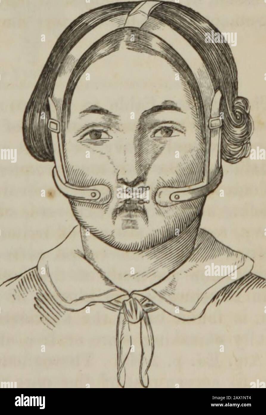The practice of surgery . edundancy should be found, after .cicatrization, it may easilybe reduced to the proper outline, by knife or scissors if need be; but Fig. 76. in general, absorption will render.all secondary interference unneces-sary. [In the last edition of his Prac-tical Surgery (Am. Reprint, 1853),Mr. Fergusson speaks very highlyof an apparatus which he almostconstantly employs, to assist theaction of the sutures in maintain-ing close apposition of the edgesof the wound. It is composed ofa semicircular spring padded atboth extremities, which are so ap-plied upon the cheeks as to ta Stock Photo