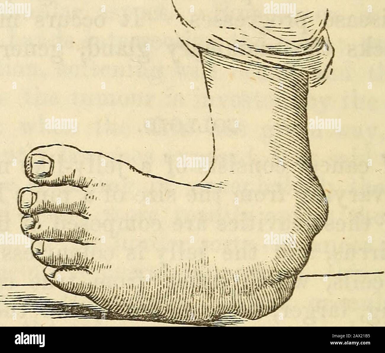 A Hand Book Of Surgery With Fifty Illustrations Ectic Club Foot This Deformity May Be Either Congenital Or Acquired The Con Genital Form Is Dependent Upon Some Disturbance Of The Cerebro Spinal System That Produces