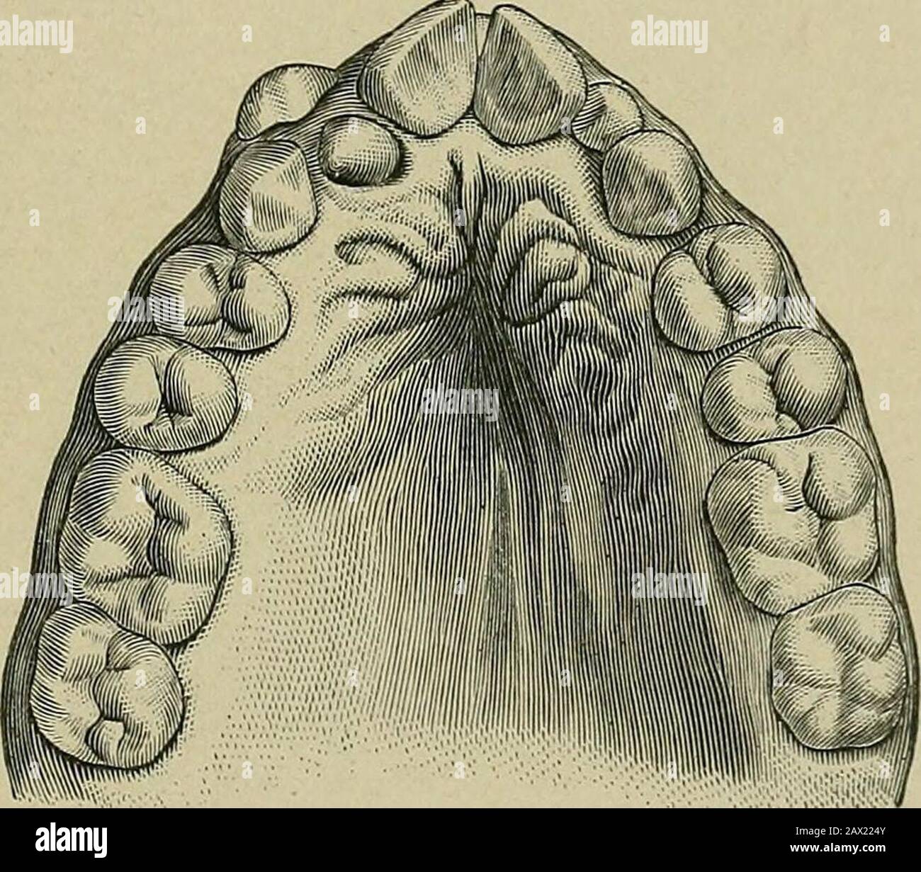 The etiology of osseous deformities of the head, face, jaws and teeth . inch. Hasbreathed through the mouth for the past six years. There isarrest of development of the bones of the face and nose. Thepatient has considerable catarrh. Is now under treatmentfor irregularities of the teeth. The jaw is much contracted,especially in the anterior part. On the right side the lateralincisor is deformed, and is represented b3^a conical tooth situ- THE HEAD, TACE, JAWS AND TEETH 369 ated internally to the other teeth. Posterior to this is thetemporary cuspid; on account of the retention of this tooththe Stock Photo