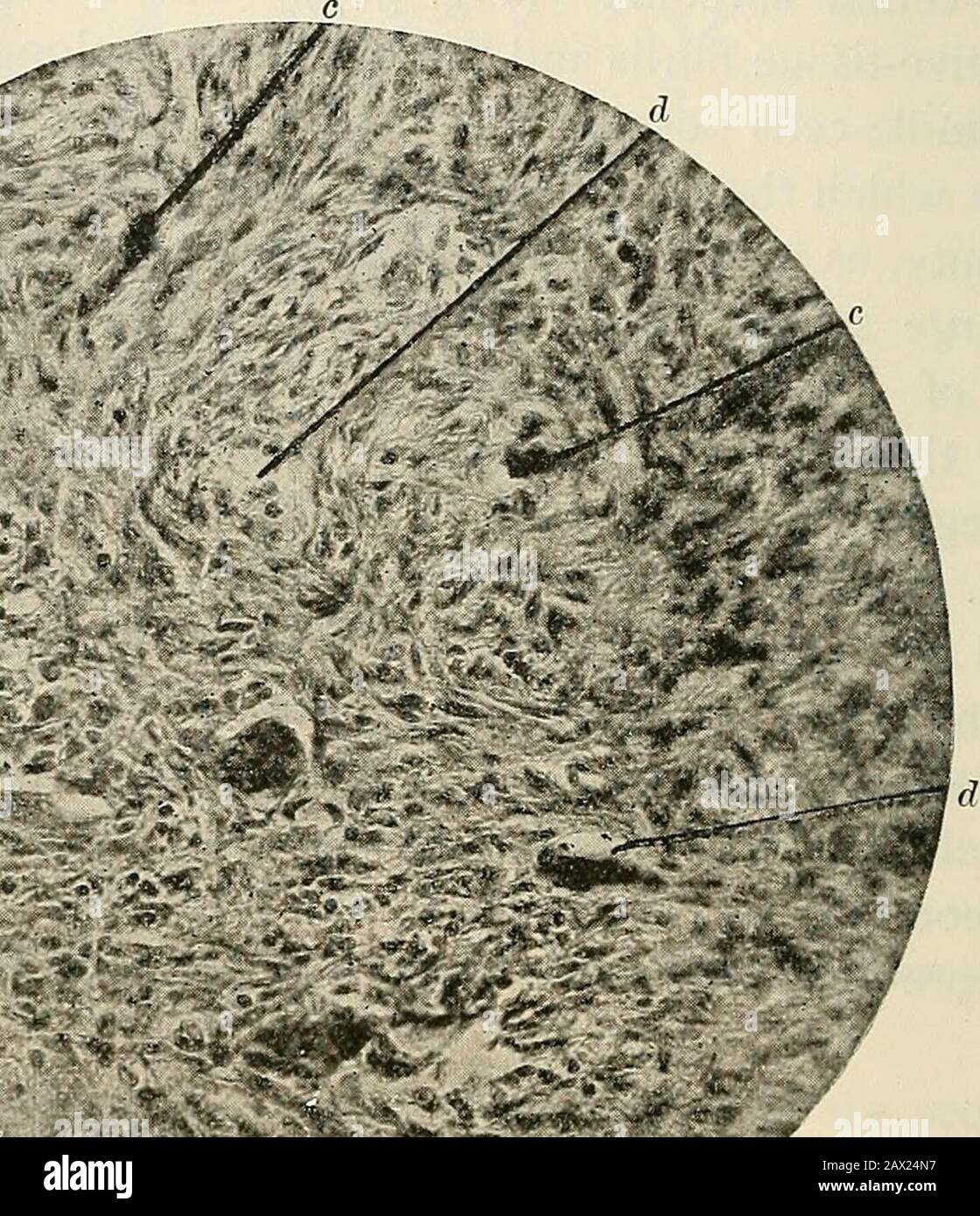 The pathology and surgical treatment of tumors . Fig. 388.—Giantcelled