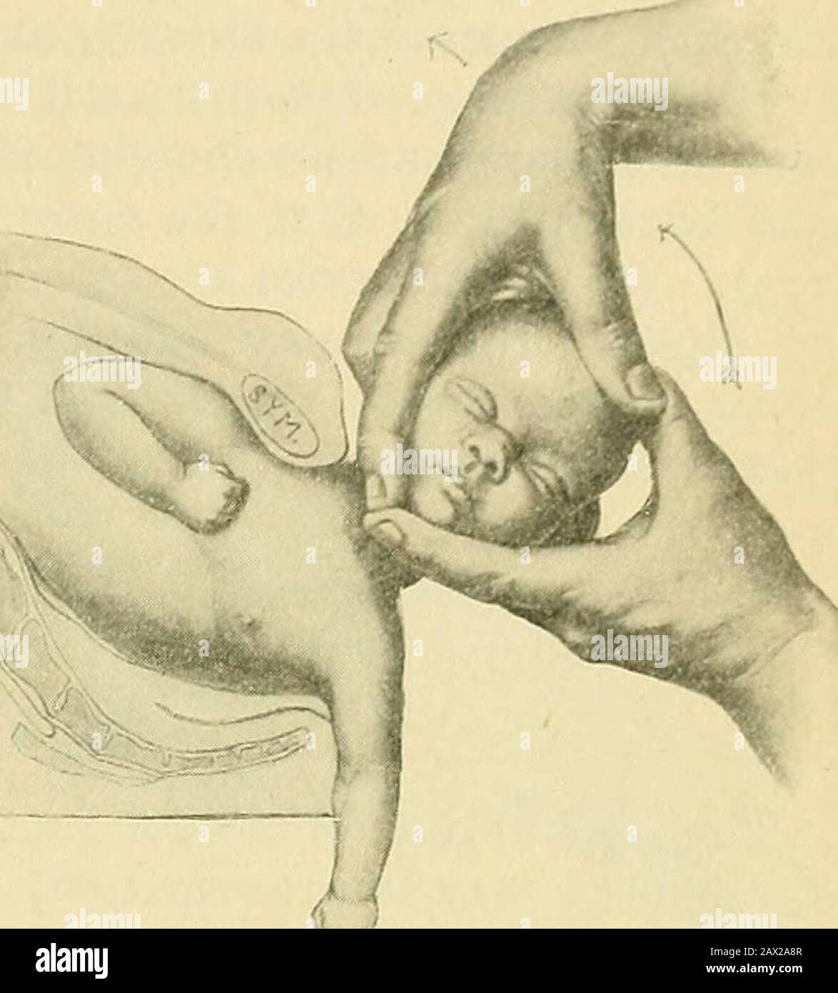 The practice of obstetrics, designed for the use of students and practitioners of medicine . Fig. 1170.—Shoulder Extraction inHead-first Labors. Directing the an-terior shoulder well up behind the sym-physis, thus securing the engagement ofthe cervico-acromial diameter. Fig. 1171.—Shoulder Extraction inHead-first Labors. Delivery of theposterior shoulder, either spontaneouslyor artificially. Stock Photo