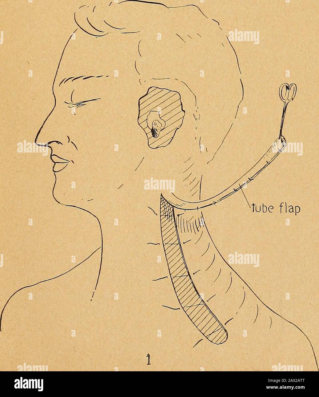 Present Status Of Plastic Surgery About The Ear Face And Neck Cartilage Cartilage Storage English Fig Vi Fig Vii Fig Viii Tubular Flap External Ear Reconstruction English 16 Beck Present Status