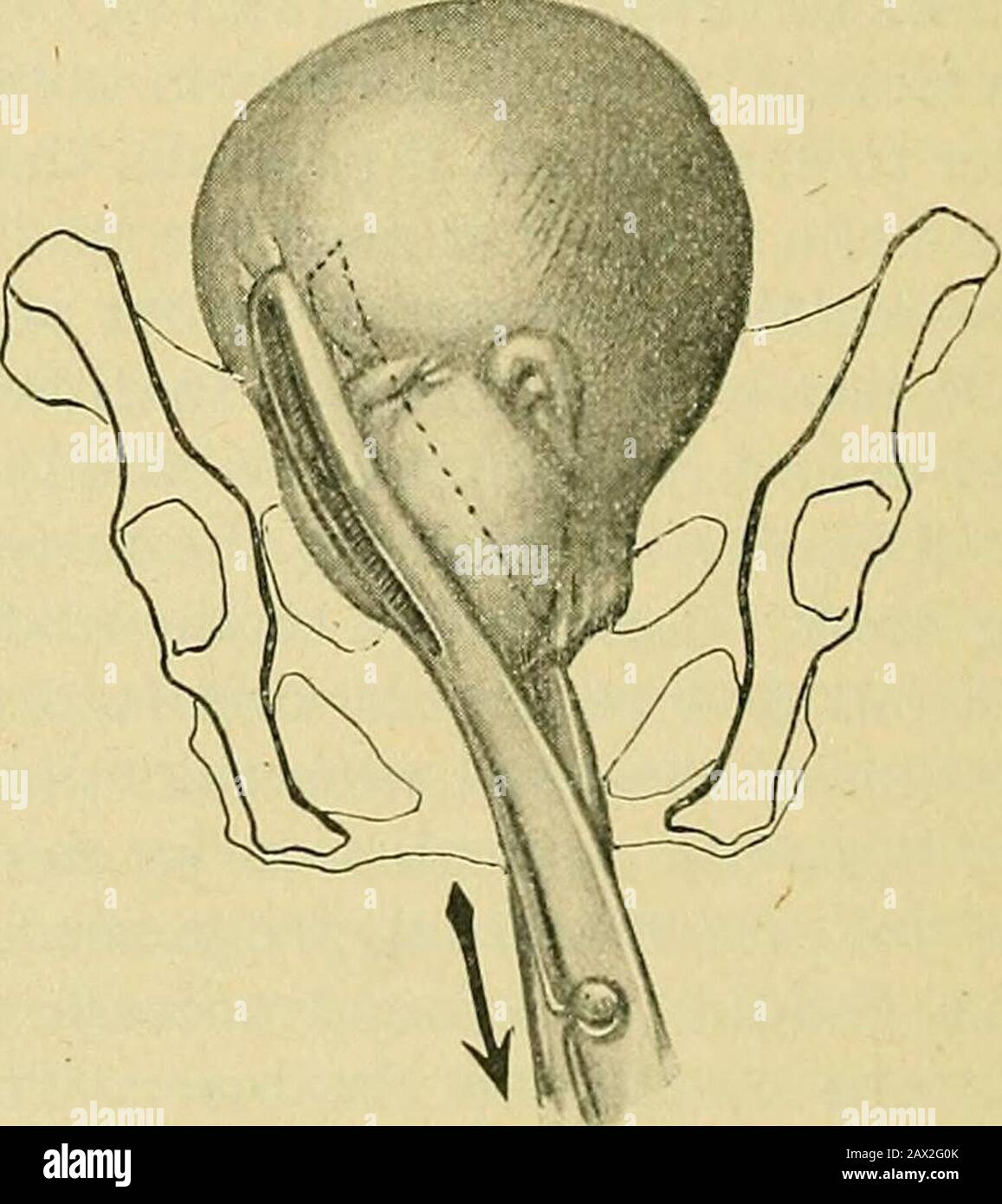 The practice of obstetrics, designed for the use of students and practitioners of medicine . Pig. 1147.—Cranioclast Applied to theBreech, in Left Sacro anterior Posi-tion. Fig. 1148.—Application of the Cranio-clast to the Decapitated Head inUtero. CEPHALOTRIPSY. 951 Persistent Mento-posterior Position (Fig. 1144).—No matter how greatthe temptation to apply thecranioclast over the forehead, this should alwavs beavoided in face presentation, and the instrument applied to the chin end of thepresenting lever. This can be accomplished by passing the solid blade into anopening at the root of the nos Stock Photo